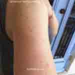 Gertrud bed bug bites 1 of 5