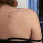 Gertrud bed bug bites 2 of 5