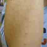 Arm of Jess with Bug Bites