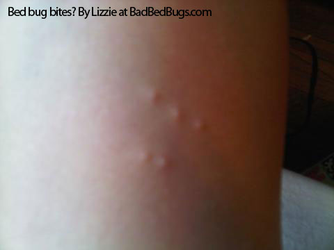 bed bug bites on black people. Does anyone have edbug bites