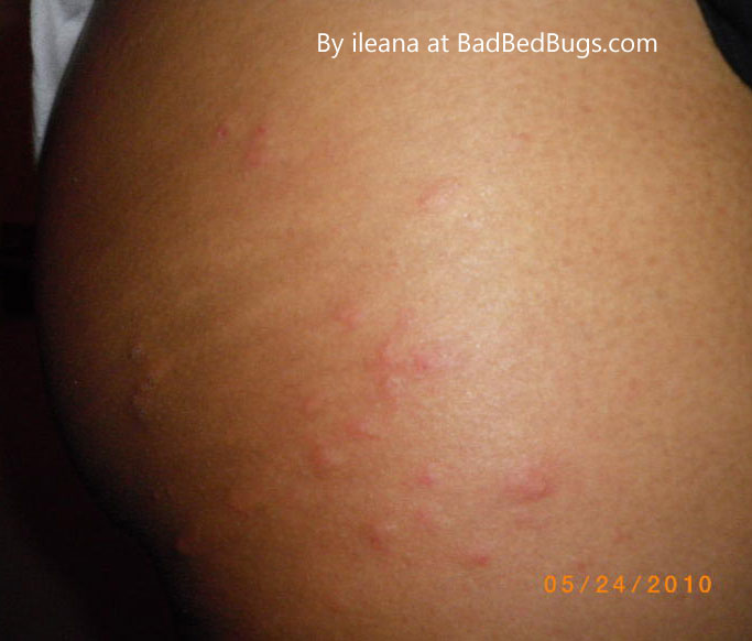 Bed Bug Bites On Black People