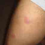 Image of bed bug bite on thigh