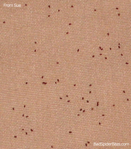 Flea Bites on Humans — Pictures, Treatment & Prevention