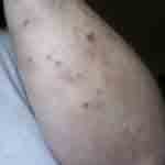 What bed bug bites look like photo 10