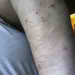 What bed bug bites look like photo 11