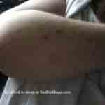 What bed bug bites look like photo 12