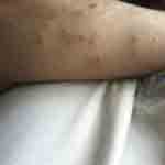 What bed bug bites look like photo 14