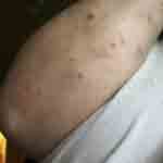What bed bug bites look like photo 15
