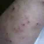 What bed bug bites look like photo 16