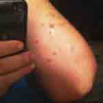 What bed bug bites look like photo 4