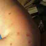 What bed bug bites look like photo 7