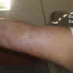 Bed bug bites on inside of Richard's arm