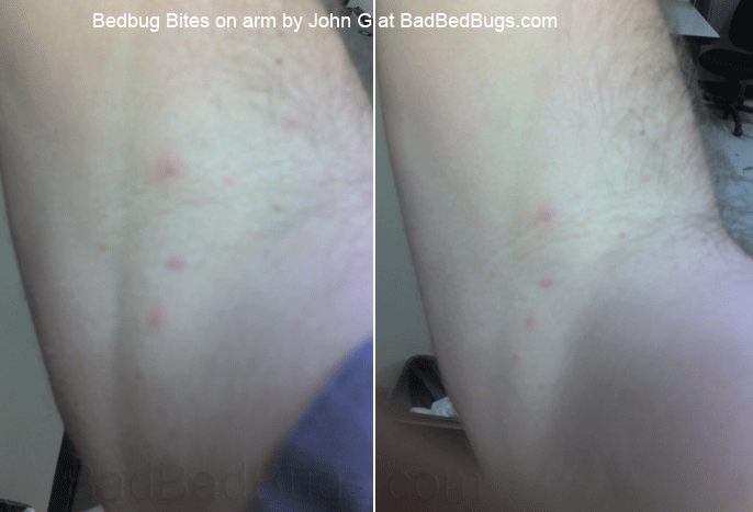 how to get rid of scars causedbed bug bites - bedding sets how to get rid of scars causedbed bug bites - bedding sets