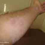 Bed bug bites on Richard's left arm