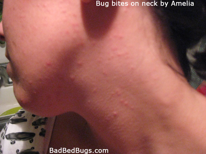 What Do Fire Ant Bites Look Like? Picture of Fire Ant Stings