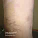 Close up of bedbug bites on arm