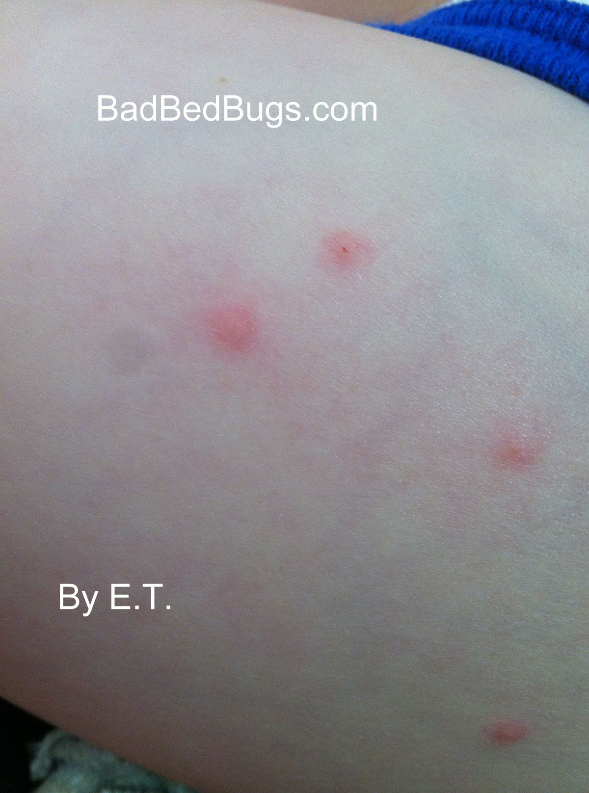 Bed Bug Bites On Legs