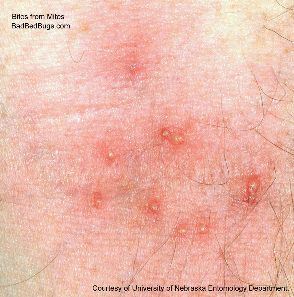 scabies bite marks