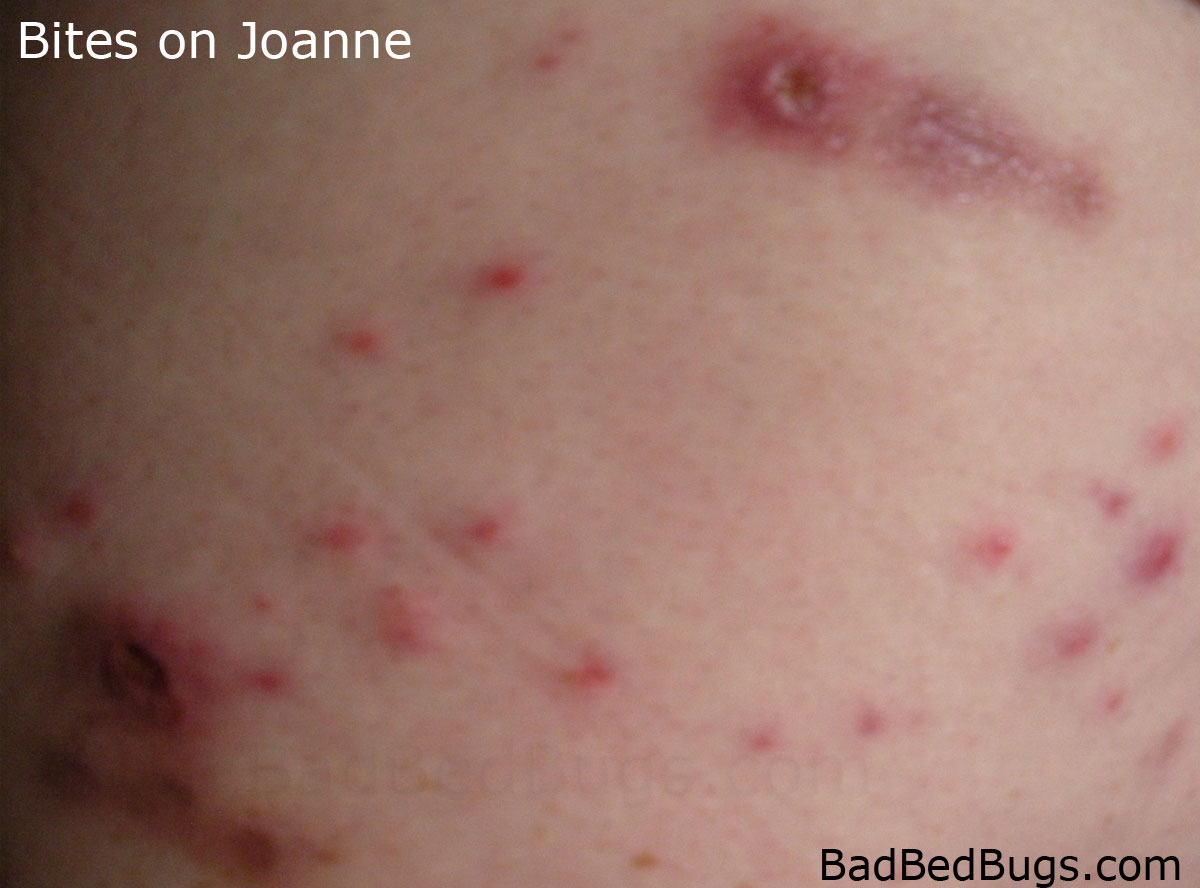 Mite Bites Symptoms Treatment And Prevention Mite Bites Symptoms Treatment And Prevention