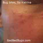 Bug bites by Katrina 3