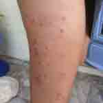 Red swollen bites on leg from bed bugs