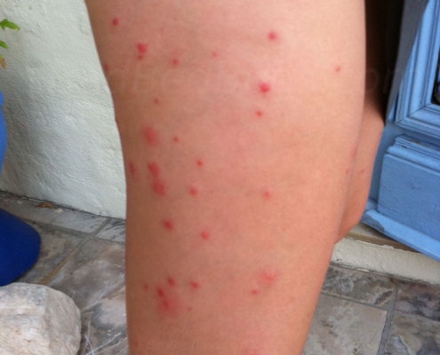 Red swollen bites on leg from bed bugs