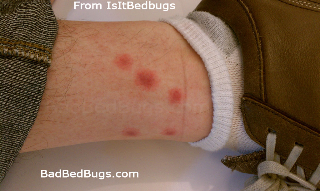 Bedbug Bites Discussion Pg 1