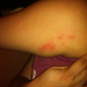 Kristen was bitten near her armpit by bed bugs.