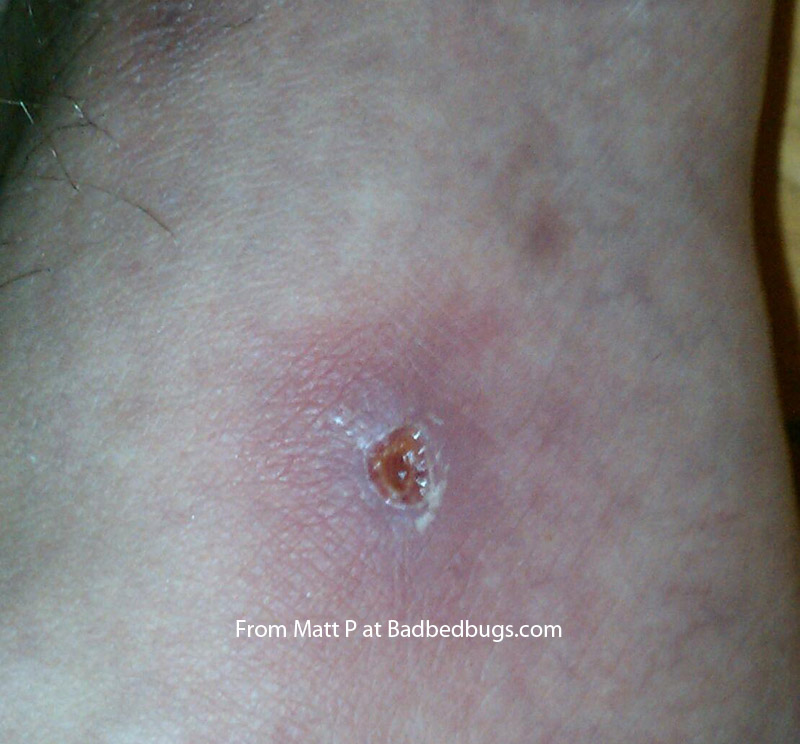 Bedbug Bites Discussion Pg 1