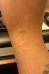 Bed bug bites on tan skin of wrist.