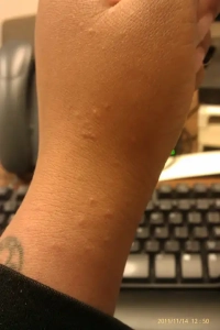 Bed bug bites on dark skin of wrist.