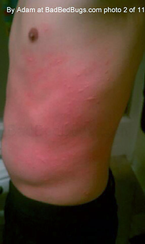 does your body reacto to bed bug bites less over time does your body reacto to bed bug bites less over time