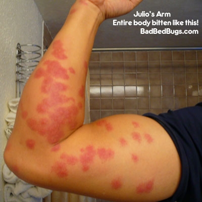 Rash from bed bug bites on the bicep and arm