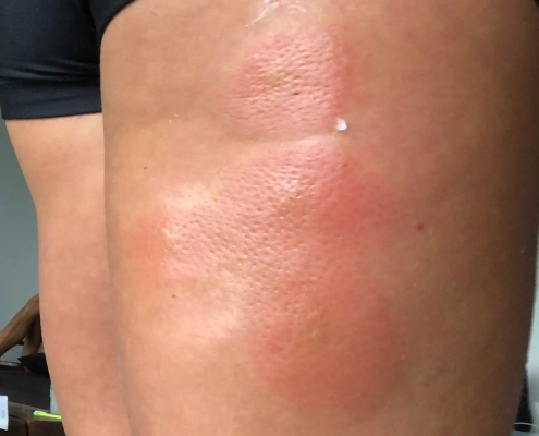 Large red rash on leg from bed bug bites.