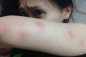 See what bed bugs look like