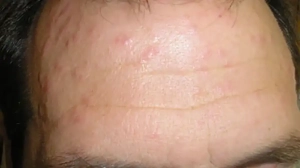 Bed bugs bite this mans forehead multiple times.