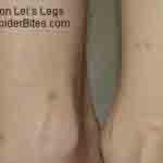 Bed bug bites on Lei's legs