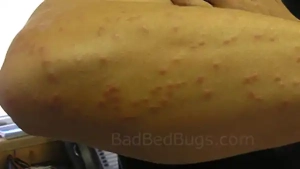 Multiple bed bug bites on back of arm.