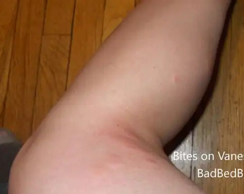 Vanessa was bitten by bedbugs on her knee.