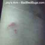 Image of bedbug bite on Joy's wrist