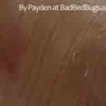 Bedbug Bite on Payden