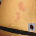 Bed bug bite pattern by Monica How Monica knew what bed bug bites look like