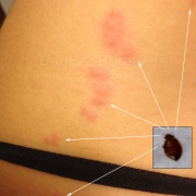 What Do Bed Bug Bites Look Like