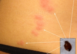 Most common pattern made when bitten by bed bugs, shown on side