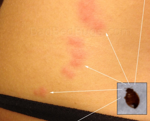 Most common pattern made when bitten by bed bugs, shown on side