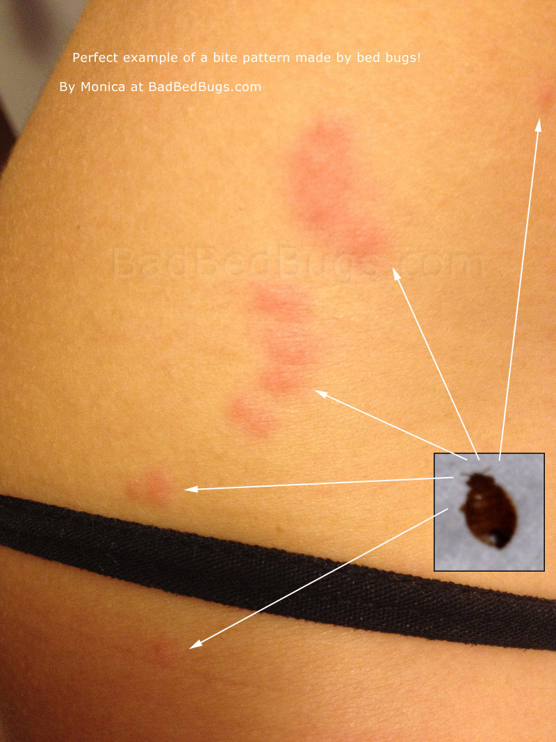 This is what bed bug bites look like