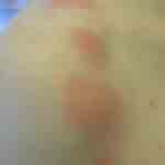 More images of bedbug bites on rachels shoulder