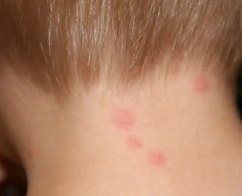 Bed bug bites in a line on the back of this boy's neck.