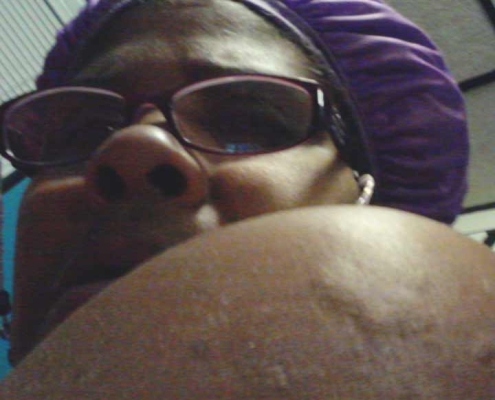 Bed Bug Bites on Black Skin Shoulder