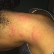 Swollen bed bug bites on neck of black woman.